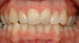 Patient 4 before orthodontic treatment at Dr Dev Orthodontics in Cheshire