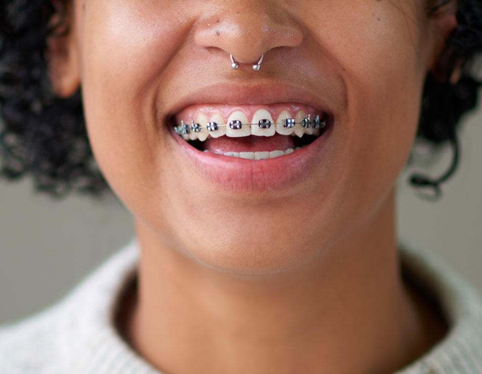 Close-up of a smile wearing fixed metal braces fitted in Cheshire