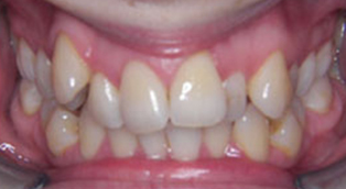 Patient 2 before orthodontic treatment at Dr Dev Orthodontics in Cheshire