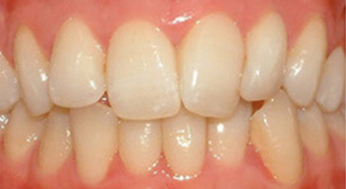 Patient 1 before orthodontic treatment at Dr Dev Orthodontics in Cheshire