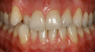 Patient 3 before orthodontic treatment at Dr Dev Orthodontics in Cheshire