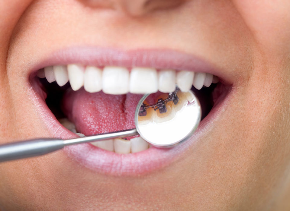 Dental mirror showing a lingual brace fitted behind the teeth in Cheshire
