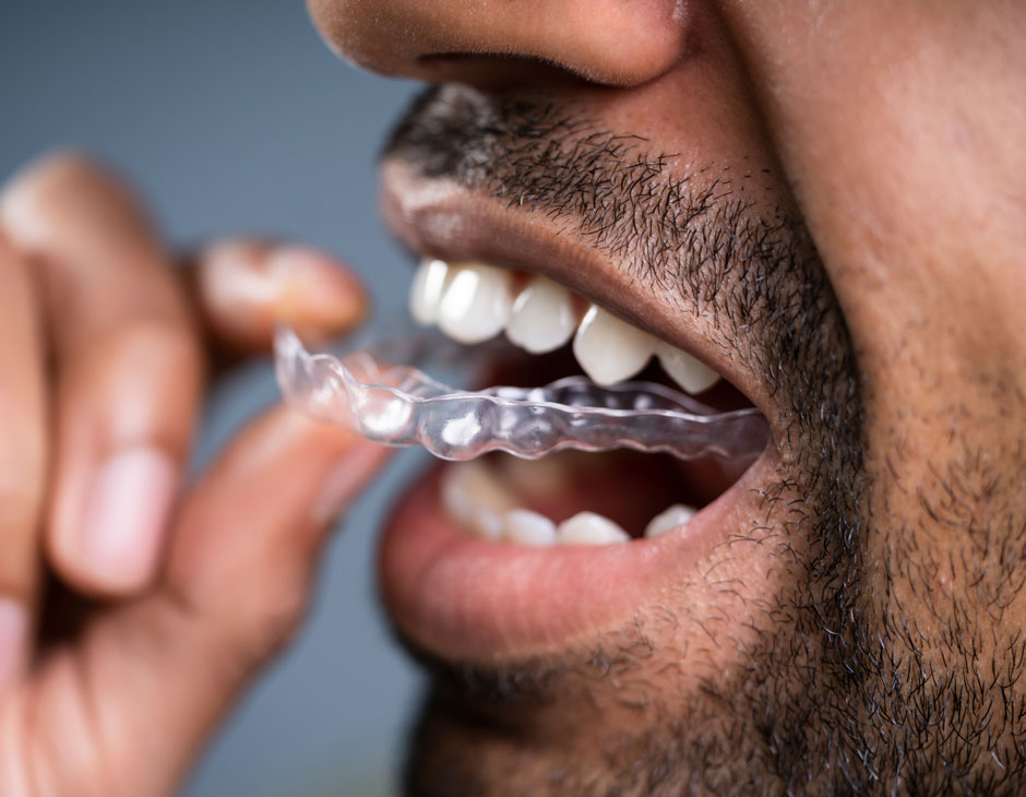 Patient fitting a clear Angel aligner tray at Dr Dev Orthodontics in Cheshire